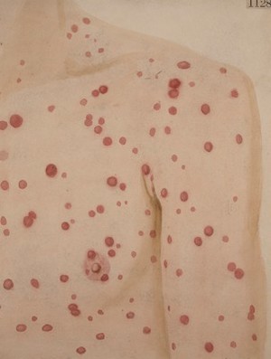 view Chest, shoulder and arm of a man with a secondary syphilitic rash