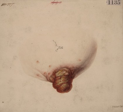 Tertiary syphilitic affection of the nipple