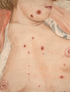 Chest of a woman with a tertiary syphilitic eruption