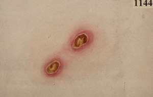 view Skin of a woman with a tertiary syphilitic eruption