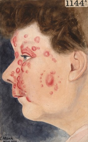 Face of a woman with tertiary syphilis