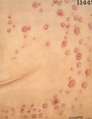 view Chest of a woman with tertiary syphilis