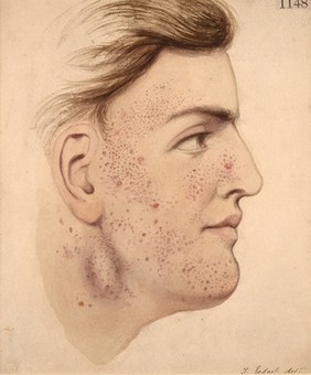 Face of a man with herpetiform syphilide