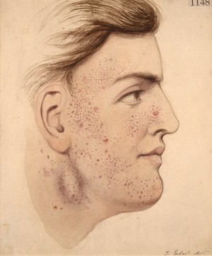 view Face of a man with herpetiform syphilide