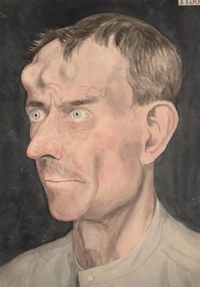 Face of a man affected with tertiary syphilis