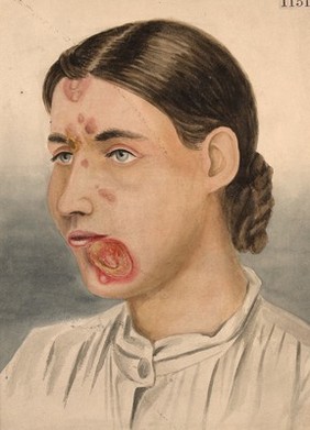 Face of a woman with tuberculated ulcerations due to tertiary syphilis