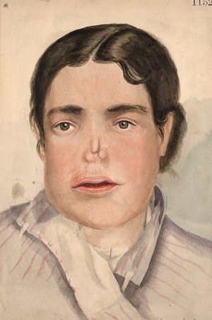 view Face of a woman with destruction of the nose due to tertiary syphilis