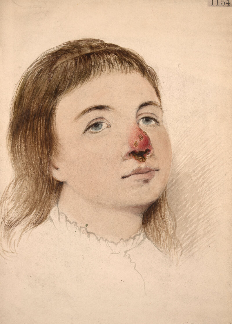 Последняя стадия сифилиса фото Ulceration of the nose, the result of congenital syphilis Wellcome Collection