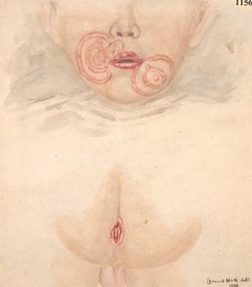 Congenital syphilitic eruption on the face and anus of a child