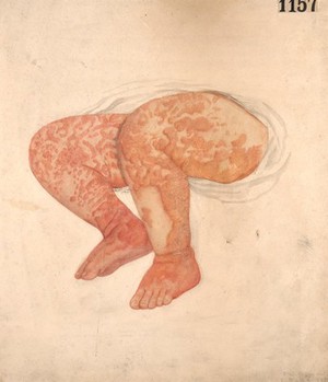 view Roseola of congenital syphilis upon the legs