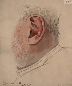 Ear of a man with numerous gouty tophi