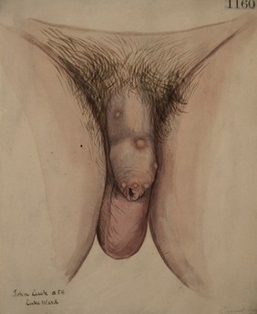 Genitals of a man with numerous gouty tophi