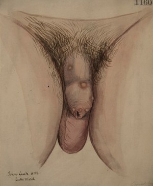 view Genitals of a man with numerous gouty tophi