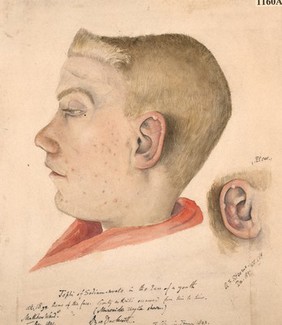 Head of a youth with gouty tophi in both ears