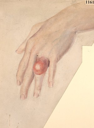 view Gouty tophus on the left ring finger