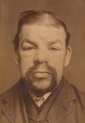 Face of a man with myxoedema