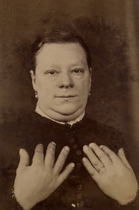 Woman with myxoedema at an early stage