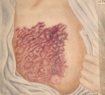 Subcutaneous haemorrhage on the chest and abdomen due to haemophilia