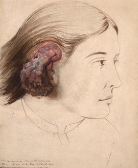 Woman whose ear was affected with arterial angioma