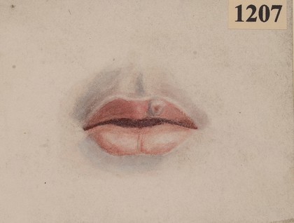 Naevus on the top lip of a male patient