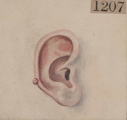 Naevus on the right ear of a male patient