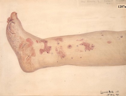 Naevoid condition of the leg and foot