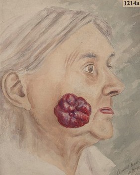 Sarcoma on the cheek of an old woman