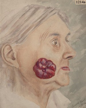 view Sarcoma on the cheek of an old woman