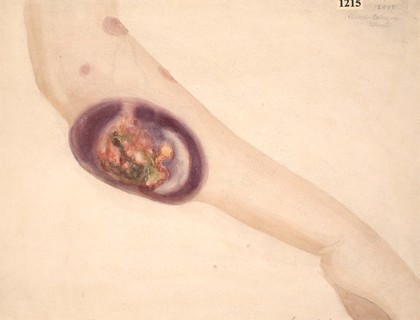 Arm of a woman with secondary sarcomatous tumours