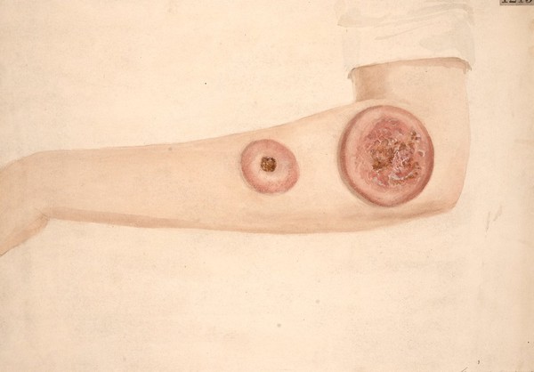 Arm of a woman with secondary sarcomatous tumours