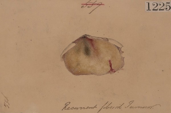 Recurrent spindle-cell sarcoma