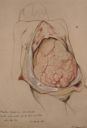 Great omentum occupied by a fibro-sarcomatous growth