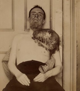 Man with a large periosteal sarcoma springing from his shoulder