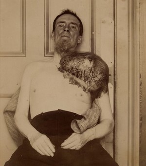 view Man with a large periosteal sarcoma springing from his shoulder