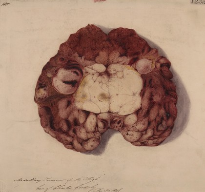 Medullary tumour of the thigh