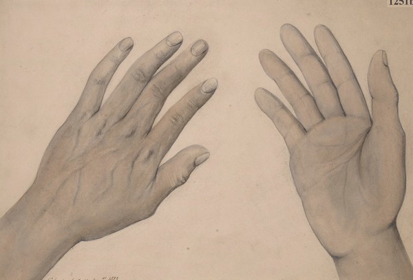 Hands of a man with peculiar staining of the skin, caused by melanotic sarcomata