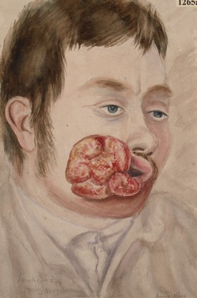 Man with extensive epithelioma at the corner of the mouth