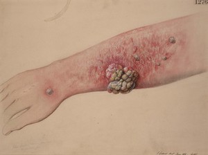 view Left forearm of a wax-refiner who had a large recurrent epitheliomatous growth