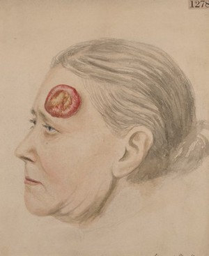 view Woman with an epithelioma growing on the left temple