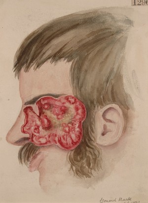 view Rodent ulcer of the left side of the face