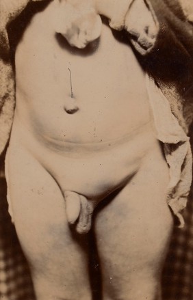 Cystic hygroma in the left groin of a child