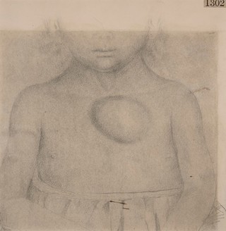 Child with congenital cystic hygroma on the chest