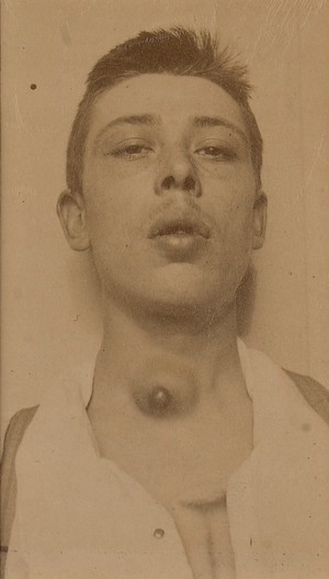 view Cyst on the neck of a young man