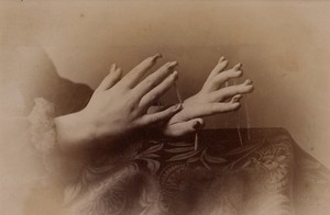 view Hands of a girl affected with onychogryphosis