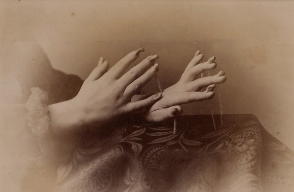 Hands of a girl affected with onychogryphosis