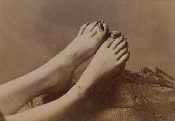 Feet of a girl affected with onychogryphosis