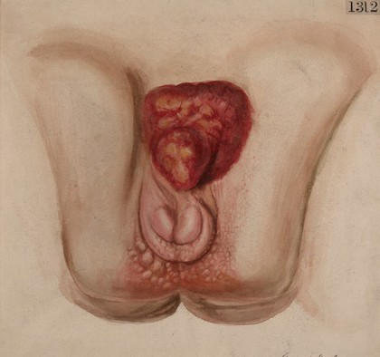 Urino-generative organs of a man who had extroversion of the bladder