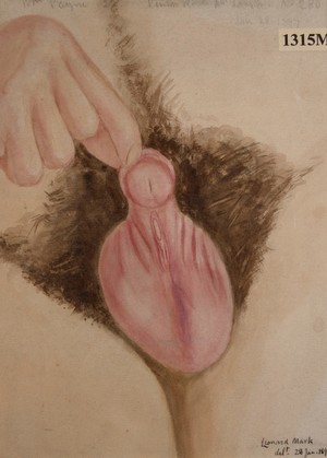 view Congenital deformity of the urethra (hypospadias)