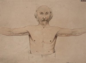 view Old man with supernumerary nipples