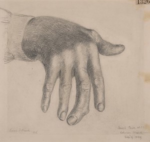 view Hand showing congenital enlargement of the second finger